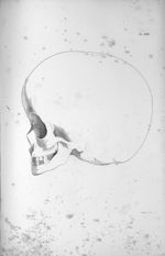 Pl. XXIII. Hydrocéphale d'un enfant de sept ans, en profil, complètement imbécile - Anatomie et phys [...]