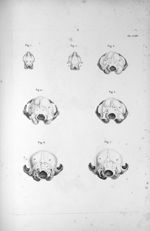 Pl. LV. Fig. 1. Une partie des hémisphères déplissées par l'hydrocéphale / Fig. 2. Crâne très-maltra [...]