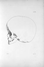 Pl. XXIII. Hydrocéphale d'un enfant de sept ans, en profil, complètement imbécile - Anatomie et phys [...]