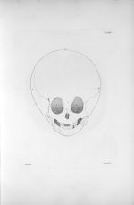 Pl. XXIV. Même hydrocéphale [enfant de sept ans complètement imbécile], vu en face - Anatomie et phy [...]