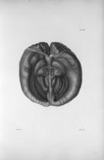 Pl. XXV. Cerveau d'une femme hydrocéphale de cinquante-cinq ans, contenant quatre litres d'eau, et j [...]