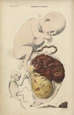 6e Livraison. Pl. 6. Maladies du placenta. Atrophie d'une portion du placenta, défaut de développeme [...]