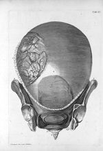 Tab. XI. [Position de l'utérus dans le ventre à la fin de la grossesse] - Tabulae anatomicae. Accedi [...]