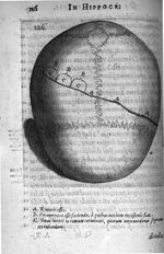 A. Rima in osse B. Foramina in osse facienda, à quibus initium excisionis fiat C. Sinus lunari in ri [...]