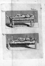 Tab. III. Fig. 1 Fig. 2 - In Hippocratis Coi medicorum omnium longe principis librum de Fracturis co [...]