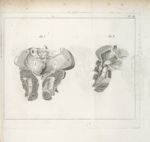 Pl. III. [Observations dur un foetus trouvé dans le mésentère d'un jeune homme de quatorze ans. Diss [...]