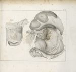 Pl. VI. [Observations dur un foetus trouvé dans le mésentère d'un jeune homme de quatorze ans. Disse [...]