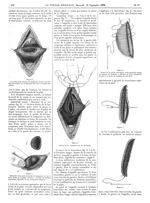 Figure 3. La vessie étant ouverte, la muqueuse dessine une bordure blanchâtre sur le fond plus foncé [...]