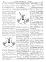 Figure 2. Écrasement de l'urètre (Muqueuse recroquevillée et retractée.) / Figure 3. Dissection du b [...]