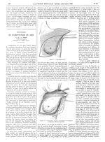 Figure 1. Lignes d'incision / Figure 2. L'incision de la peau est terminée ; on commence la dissecti [...]