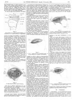 Figure 2. Aspect général de la membrane thyro-hyoïdienne avec la projection de ses rapports glottiqu [...]