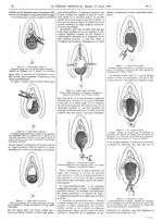 Figure 2. Colporraphie antérieure. Deuxième piqûre faite en territoire déjà anesthésié, l'aiguille s [...]