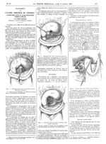 Fig. 1. Dissection d'un ulcère de la petite courbure adhérant au pancréas / Fig. 2. Dissection d'un  [...]