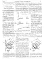 Fig. 1. Schéma montrant la façon de tailler le greffon (par dédoublement de la paroi crânienne), de  [...]