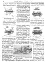 Fig. 4. Greffe hétéroplastique morte, après résection étendue du nerf / Fig. 5. Greffe hétéroplastiq [...]