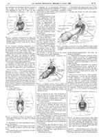 Fig. 15. Extirpation périnéo-sacrée (2e temps). Les incisions postérieure et latérale ont été pratiq [...]