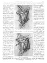 Fig. 3. Dissection de bas en haut de la veine jugulaire interne / Fig. 4. Découverte du nerf spinal  [...]