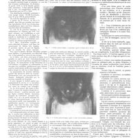 0088 - Page 84 - Travaux originaux. La coxite gonococcique. Contribution à l'étude de ses formes cliniques. Par MM. L. Langeron... et J. Delcour...