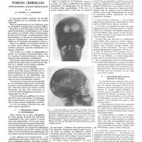 0151 - Page 145 - Travaux originaux. Étude critique de quelques méthodes de localisation des tumeurs cérébrales. L'encéphalographie lipiodolée sinuso-veineuse. Par MM. J.-A. Sicard et J. Haguenau