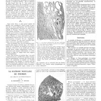 0202 - Page 196 - Travaux originaux. Travail du musée d'anatomie pathologique générale à l'hôpital Boucicaut. La maladie de Buerger. Par MM. M. Letulle, J. Marchak et G. Boyer / La sclérose nodulaire du poumon. Ses images radiologiques. Par MM. M. Macaigne et P. Nicaud