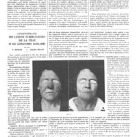 0205 - Page 199 - Travaux originaux. La sclérose nodulaire du poumon. Ses images radiologiques. Par MM. M. Macaigne et P. Nicaud / Curiethérapie des lésions tuberculeuses de la peau et des adenopathies bacillaires. Par MM. P. Degrais et Anselme Bellot