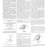 0207 - Page 201 - Travaux originaux. Curiethérapie des lésions tuberculeuses de la peau et des adenopathies bacillaires. Par MM. P. Degrais et Anselme Bellot / Clinique chirurgicale de l'hôpital maritime de Sainte-Anne. La luxation récidivante de l'épaule (variété antéro-interne). Procédé opératoire. Par Oudard...