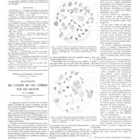 0457 - Page 451 - Travaux originaux. Travail de la clinique de M. Le professeur Tixier. A propos des accidents graves liés à l'éruption vicieuse de la dent de sagesse. Par MM. E. Pollosson... et M. Dechaume... / Bibliographie / Clinique gynécologique de Bucarest (Professeur C. Daniel). Diagnostic du cancer du col utérin par les frottis. Par A. Babès...