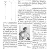 0531 - Page 525 - Chroniques, variétés et informations. Instruments nouveaux. Un punch combiné avec la haute fréquence pour le traitement de certains cas de rétention / Curiosités médicales. Volumineux lipome sous-pectoral [Vielle et Eysseric] / La médecine à travers le monde. Belgique / Brésil