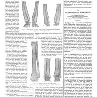 0552 - Page 546 - Travaux originaux. L'ostéodermopathie hypertrophiante. Par MM. Marcel Labbé et Paul Renault / La splénomégalie égyptienne. Par Pavlos Petridis...