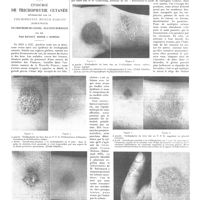 0615 - Page 609 - Travaux originaux. Travail du service et du laboratoire de M. Ravaut à l'hôpital Saint-Louis. Épidémie de trichophytie cutanée déterminée par le trichophyton niveum radians (Sabouraud). Polymorphisme des lésions - Réactions humorales. Par MM. Paul Ravaut, Basch et Rabeau