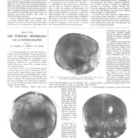 0618 - Page 612 - Travaux originaux. Travail du service et du laboratoire de M. Ravaut à l'hôpital Saint-Louis. Épidémie de trichophytie cutanée déterminée par le trichophyton niveum radians (Sabouraud). Polymorphisme des lésions - Réactions humorales. Par MM. Paul Ravaut, Basch et Rabeau / Diagnostic des tumeurs cérébrales par la ventriculographie. Par MM. Cl. Vincent, P. Cossa et M. David