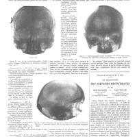 0620 - Page 614 - Travaux originaux. Travail du service et du laboratoire de M. Ravaut à l'hôpital Saint-Louis. Diagnostic des tumeurs cérébrales par la ventriculographie. Par MM. Cl. Vincent, P. Cossa et M. David / Travail du service de M. E. Rist. Le diagnostic des sténoses bronchiques. Par MM. René Huguenin... et André Soulas...