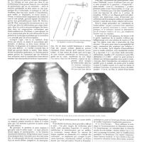0621 - Page 615 - Travaux originaux. Travail du service de M. E. Rist. Le diagnostic des sténoses bronchiques. Par MM. René Huguenin... et André Soulas...