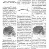 0695 - Page 689 - Travaux originaux. Nouvelle technique de l'encéphalographie artérielle. Quelques cas de localisation de tumeurs cérébrales. Par Egas Moniz