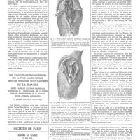 0701 - Page 695 - Travaux originaux. Fibro-myosite arthritique. Fréquence formes pures et formes associées aux névrites traitement par le massage dur et profond. Par Maurice de Langenhagen / Voie d'accès trans-trochanstérienne sur la fosse iliaque externe dans les opérations ostéo-plastiques de la hanche «butée» dans les luxations congénitales, arthrodèses et «verrouillage» de la hanche dans les pseudahthroses de la coxalgie ou des arthrites déformantes. Par Jacques Calvé / Sociétés de Paris. Académie des sciences. 14 mai 1928