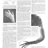 0807 - Page 801 - Travaux originaux. La mélorhéostose (Hyperostose d'un membre «en coulée»). Par André Léri... et J.-A. Lièvre...