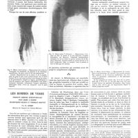 0811 - Page 805 - Travaux originaux. La mélorhéostose (Hyperostose d'un membre «en coulée»). Par André Léri... et J.-A. Lièvre... / Les hommes de verre. Fragilité osseuse hérédofamiliale avec crâne à rebord sclérotiques bleues et troubles auditifs. Par E. Apert...