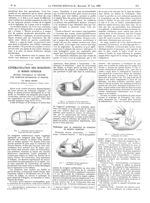 Fig. 1. Première séance opératoire : tracé des incisions cutanées / Fig. 2. Première séance opératoi [...]