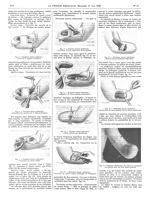 Fig. 5. Première séance opératoire : suture de la capsule articulaire / Fig. 6. Première séance opér [...]