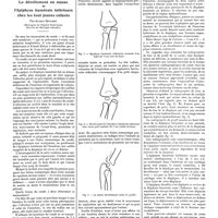1445 - Page 1435 - Petites cliniques de «la presse médicale». N° 56. Le décollement en masse de l'épiphyse humérale inférieure chez les tout jeunes enfants. Par Albert Mouchet...