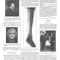 1466 - Page 1456 - Chroniques, variétés et informations. Livres nouveaux. Diagnostic et thérapeutique par le lipiodol (Clinique et radiologie, par J.-A. Sicard... et J. Forestier... (Masson et Compagnie, éditeurs), Paris... [A. Laquerrière] / Variétés. Un alerte centenaire [B. Smilyanitch] (Voir les nouvelles, p. 1442)
