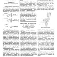 1503 - Page 1493 - Travaux originaux. Sur un procédé de repérage vertébral. Introduction par voie sous-cutanée d'un repère métallique dans une apophyse épineuse. Par Jacques Calvé... / L'injection intraveineuse en position déclive. Par Ch. Mantoux (Cannes-le-Cannet)...