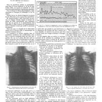 1573 - Page 1563 - Travaux originaux. L'opothérapie splénique dans le traitement de la tuberculose. Résultats cliniques. Par M. Bayle (de Cannes)