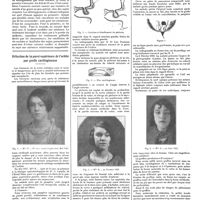 1614 - Page 1604 - Petites cliniques de «la presse médicale». N° 60. Une forme tardive d'anorexie mentale. Par Marcel Nathan / Réfection de la paroi supérieure de l'orbite par greffe cartilagineuse [Pierre Z. Rhéaume ; François Bareaux]