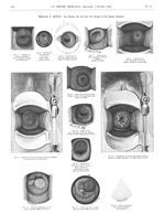 Fig. 4. Ectropien ou éversien congénitale de la muqueuse cervicale, avec inflammation / Fig. 5. Aspe [...]