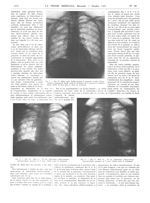 Fig. 1. Obs. IV : Même sujet. Traitée pendant la grossesse et après l'accouchement ; continuation de [...]