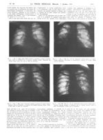 Fig. 4. Obs. V : Même sujet. Traitée pendant la grossesse et depuis l'accouchement. Arrêt de l'évolu [...]