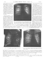 Fig. 8. Obs. VIII : Même sujet. L'arrêt de la poussée obtenu par la première série du traitement, av [...]