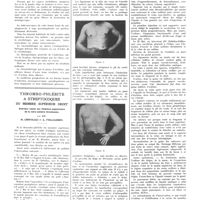 0084 - Page 84 - Travaux originaux. Les formes lentes de l'infection méningococcique par MM. Henri Roger... et Yves Poursines... / Thrombo-phlébite à streptocoques du membre supérieur droit. Guérison rapide par résection segmentaire de la veine axillaire thrombosée, par MM. M. Chifoliau et A. Folliasson