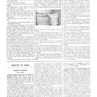0085 - Page 85 - Travaux originaux. Thrombo-phlébite à streptocoques du membre supérieur droit. Guérison rapide par résection segmentaire de la veine axillaire thrombosée par MM. M. Chifoliau et A. Folliasson / Sociétés de Paris. Académie de médecine. 5 janvier 1932